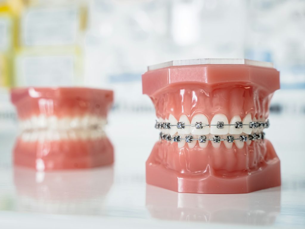 Close-up of teeth with orthodontic braces