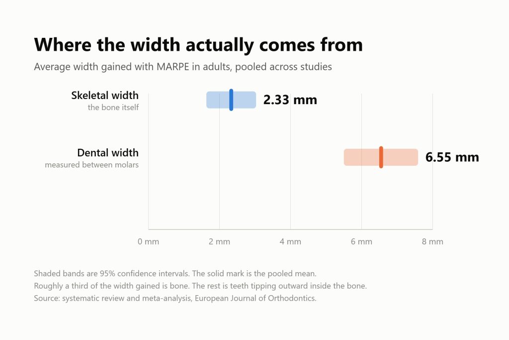 Chart comparing average width gained with MARPE in adults: skeletal width 2.33 mm and dental width 6.55 mm, with 95% confidence intervals.